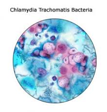 chlamydia